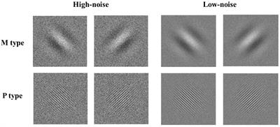 Visual Dysfunction in Chinese Children With Developmental Dyslexia: Magnocellular-Dorsal Pathway Deficit or Noise Exclusion Deficit?